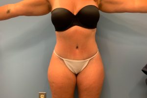 after tummy tuck front view female patient case 5452