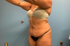 before tummy tuck left angle view female patient case 5452
