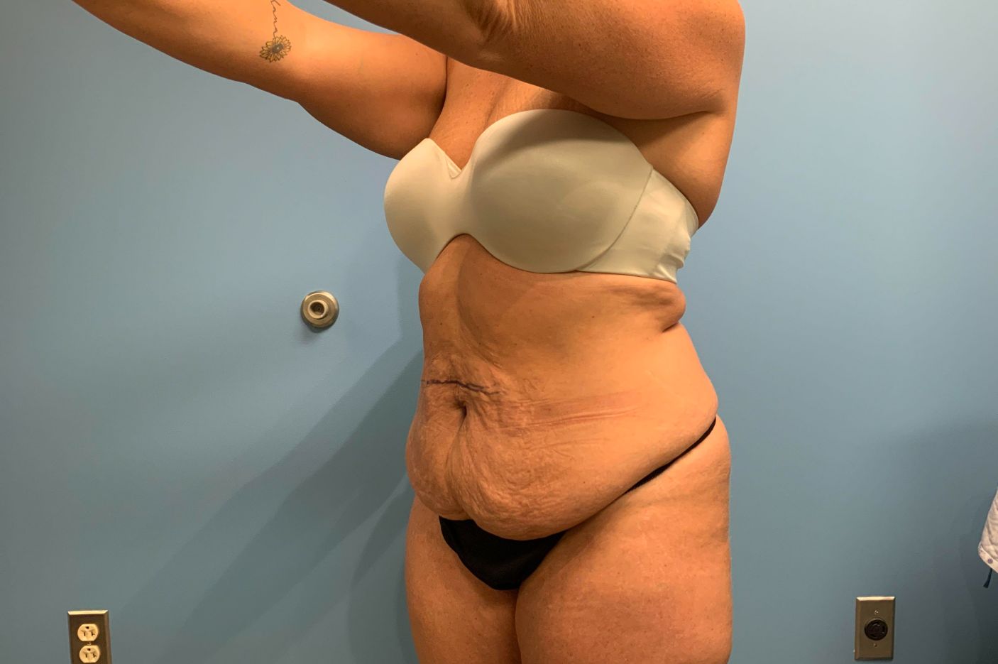 before tummy tuck left angle view female patient case 5452