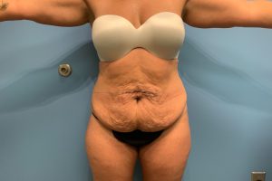 before tummy tuck front view female patient case 5452