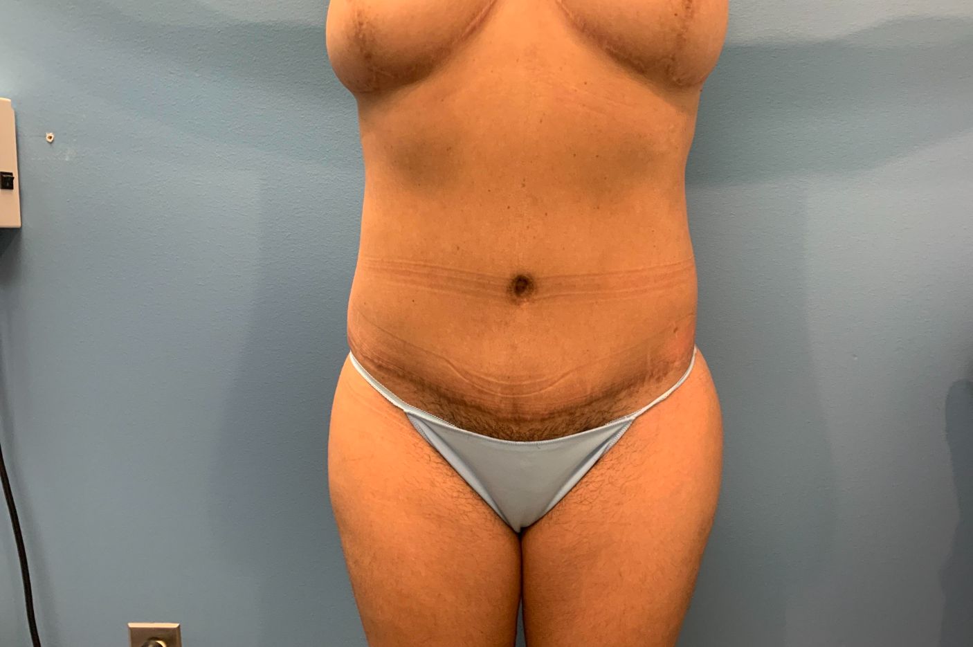 after tummy tuck front view female patient case 5457