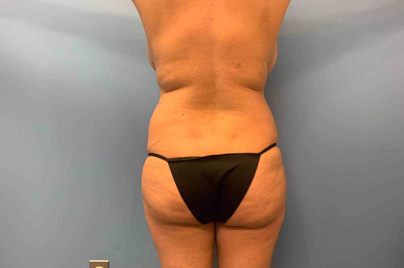 before tummy tuck back view female patient case 5457