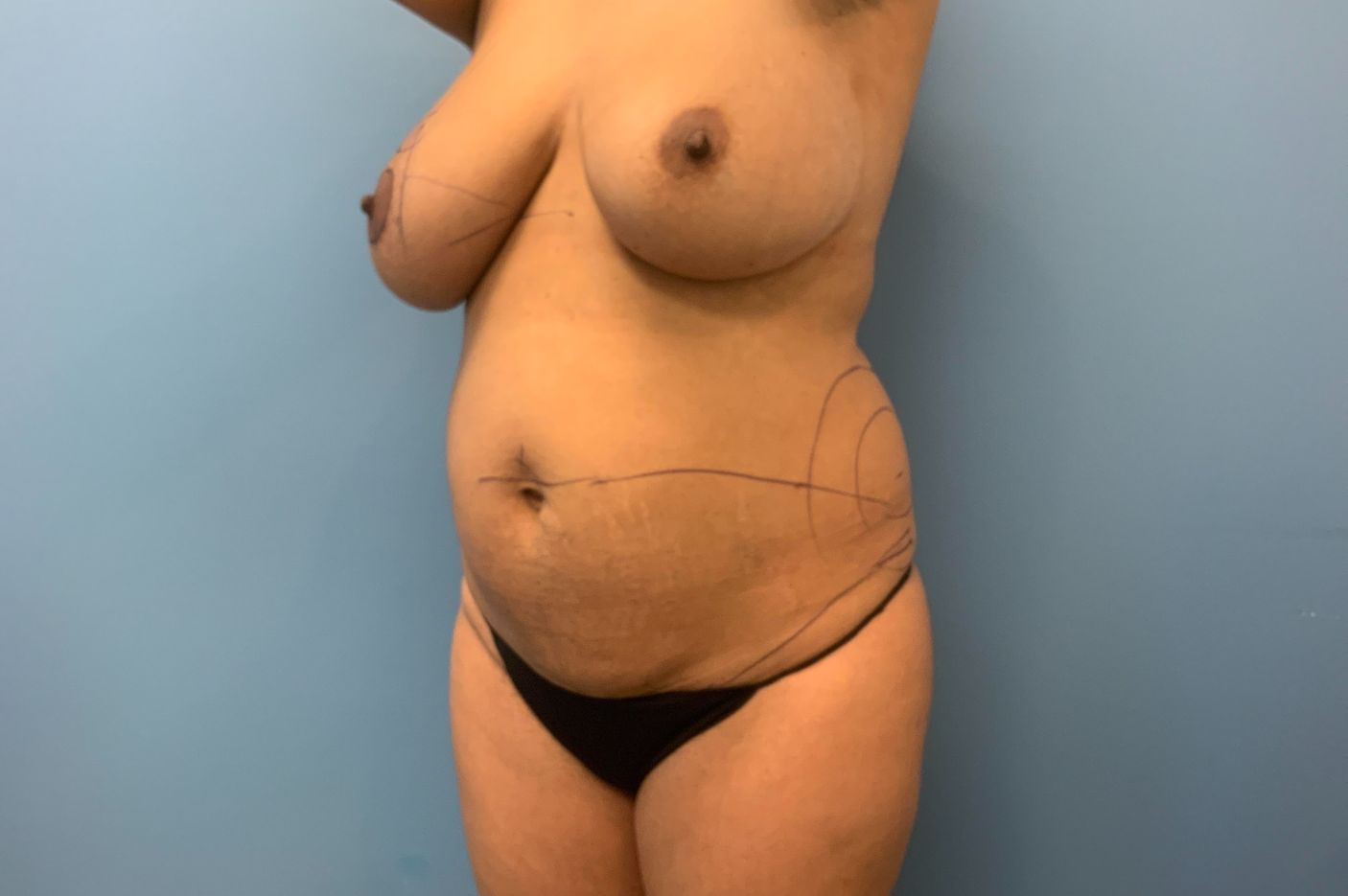 before tummy tuck left angle view female patient case 5457