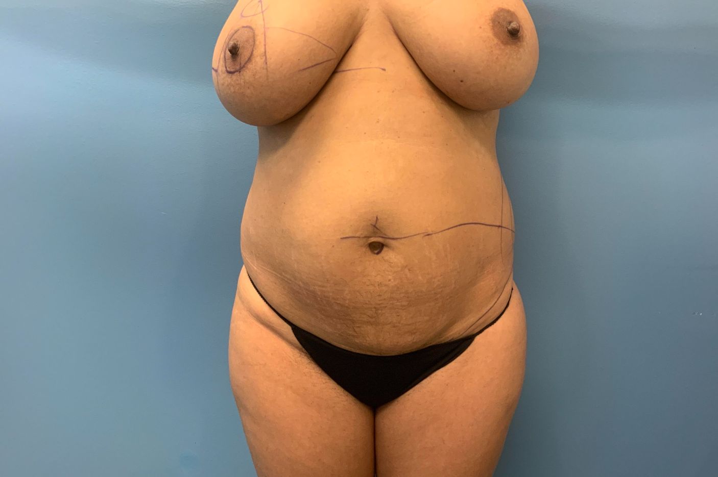 before tummy tuck front view female patient case 5457