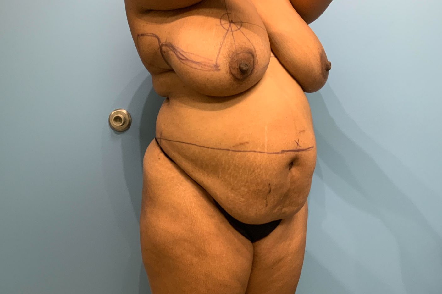 before tummy tuck right angle view female patient case 5464