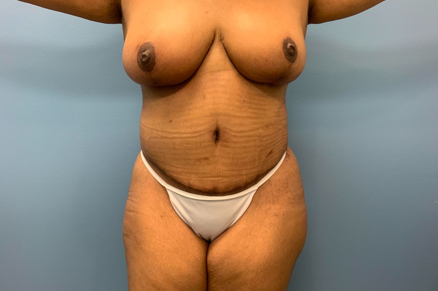 after tummy tuck front view female patient case 5464