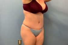 after tummy tuck right angle view female patient case 5469