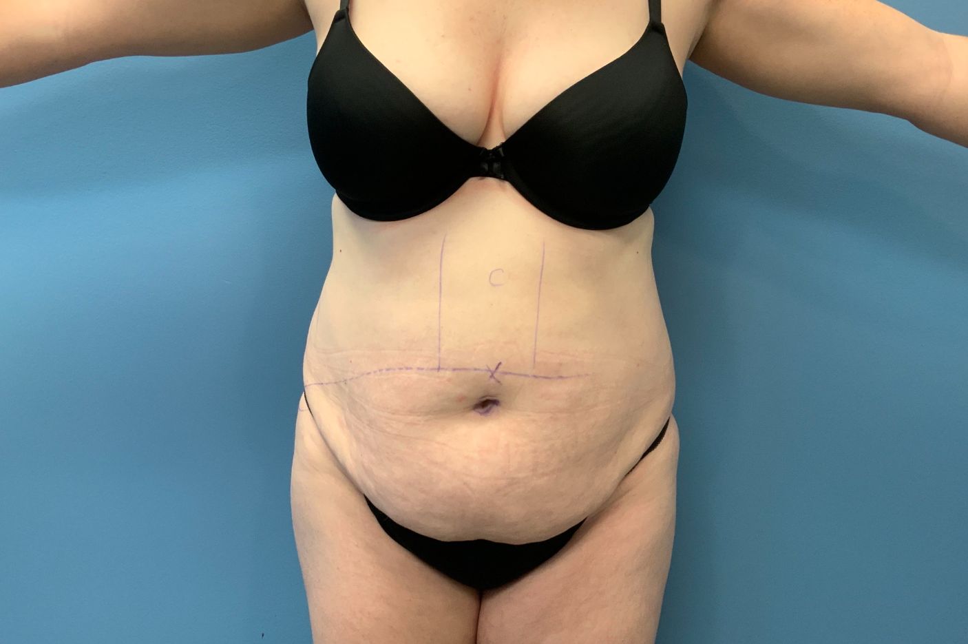 before tummy tuck front view female patient case 5469