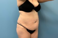before tummy tuck right angle view female patient case 5469