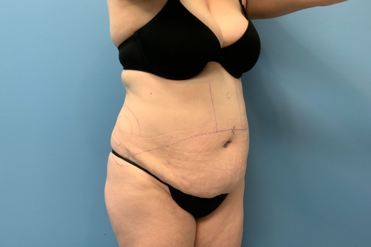 before tummy tuck right angle view female patient case 5469