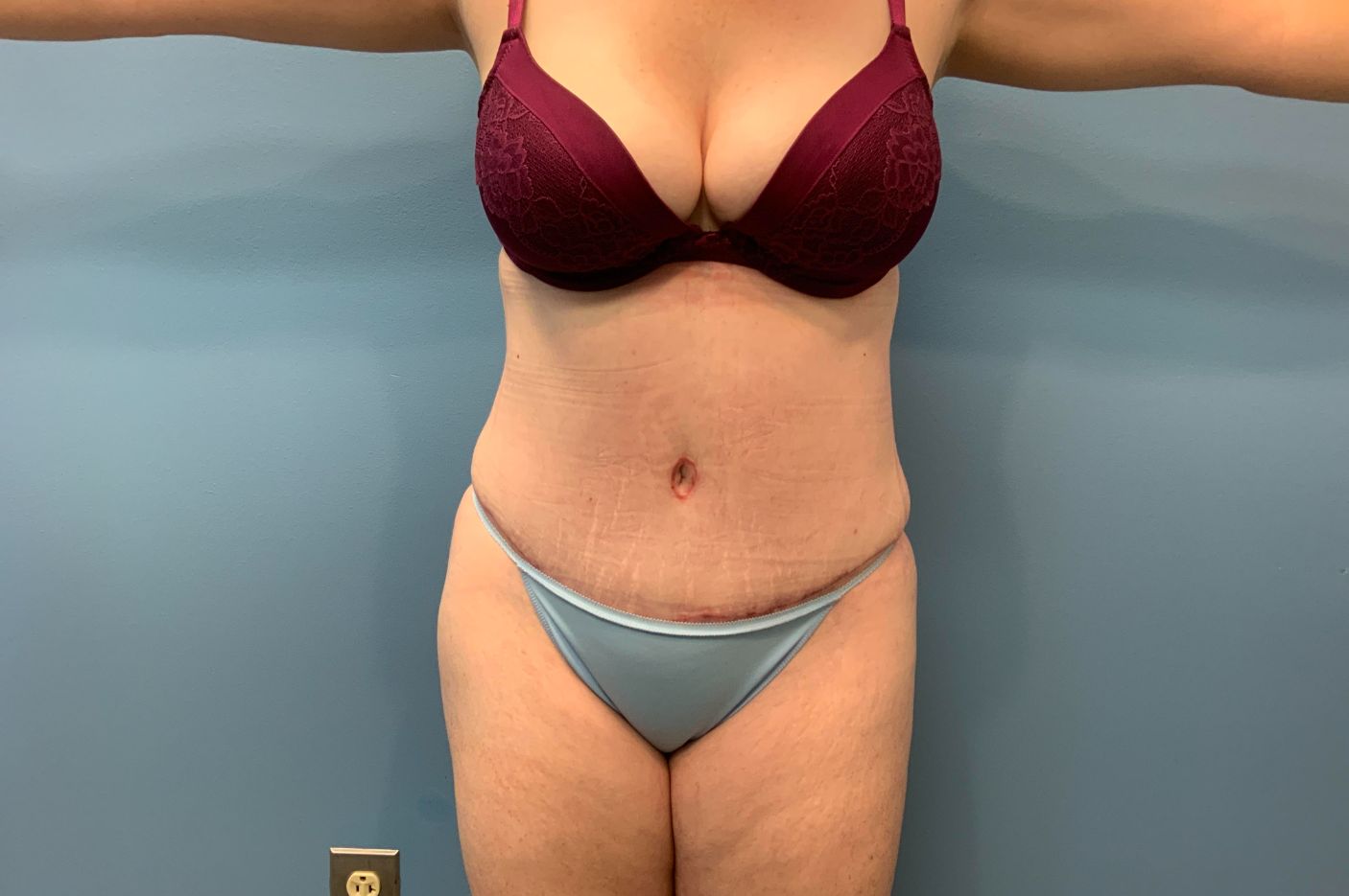 after tummy tuck front view female patient case 5469